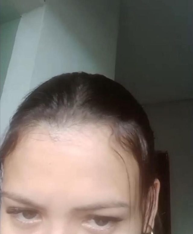 Cliente mostrando a linha do cabelo na testa